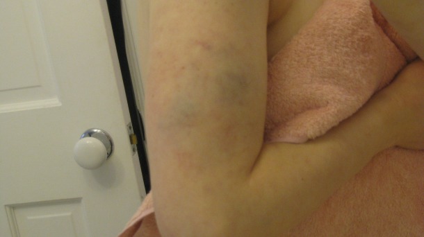 Bruises from Dandelion Market bouncer right upper arm 120813